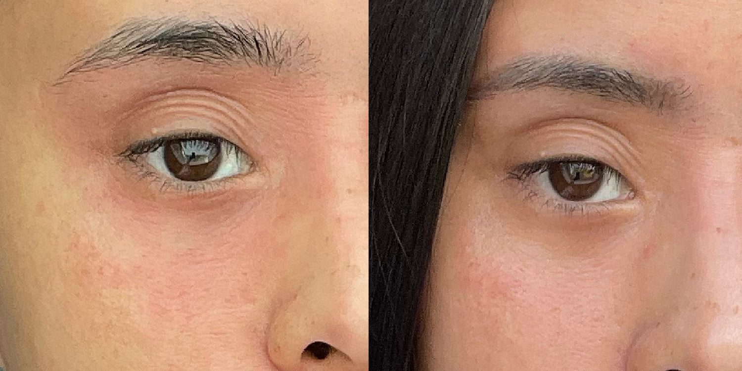 Natürliche Alternative zu Cortison bei Neurodermitis