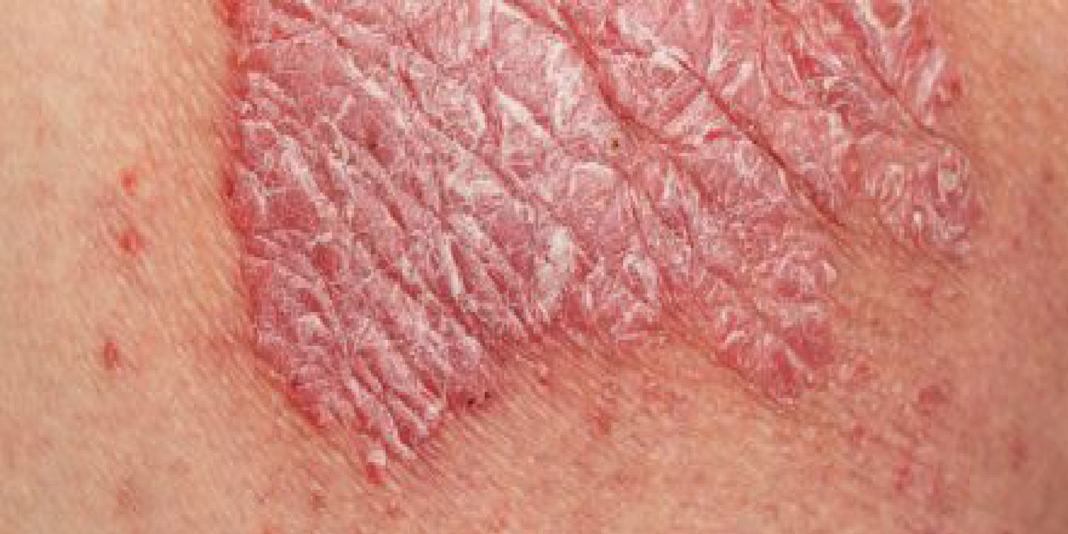 Kann ich Schuppenflechte positiv beeinflussen?