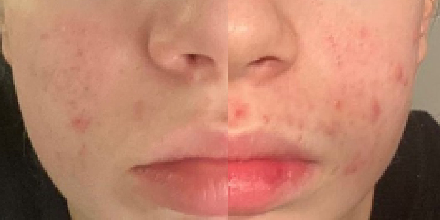 Was kann ich bei Akne tun?