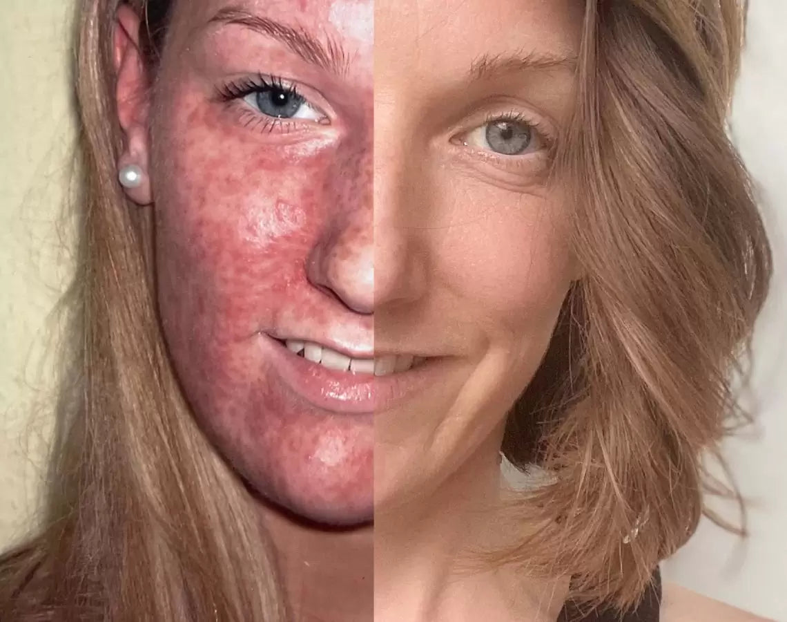 Periorale Dermatitis und der Weg da raus.