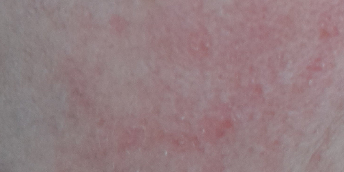 Wie kannst du Rosacea am besten behandeln?